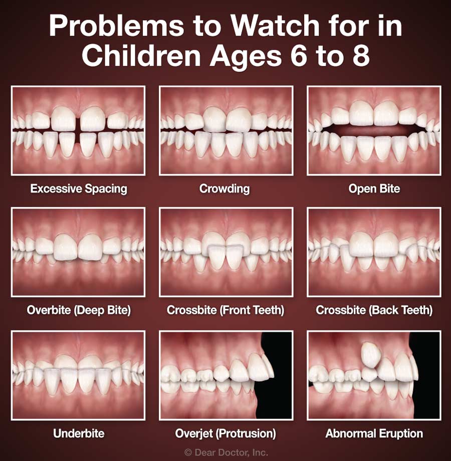 Problems to watch for in children ages 6-8: Excessive spacing, crowding, open bite,overbite, crossbite(front teeth), crossbite (back teeth) , underbite, overjet(protrusion), Abnormal Eruption